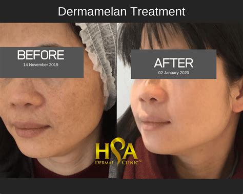 Dermamelan Peel An Effective and Affordable Solution For Pigmentation