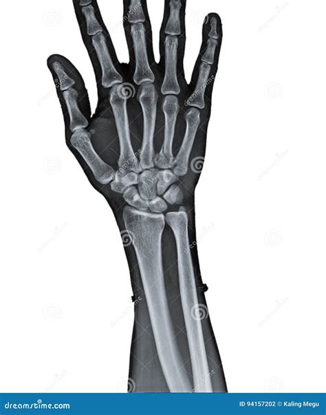 X Ray of human hand. stock photo. Image of bony, check - 94157202