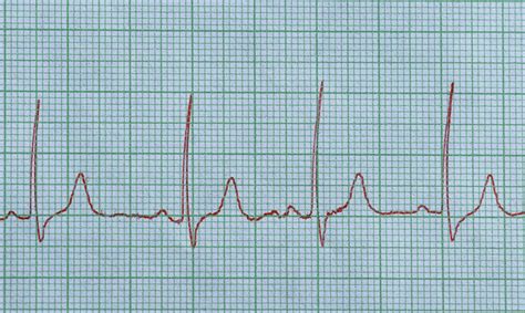 Sinus Rhythm: What's Normal and Not