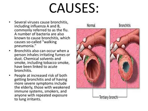 PPT - BRONCHITIS PowerPoint Presentation - ID:1857430