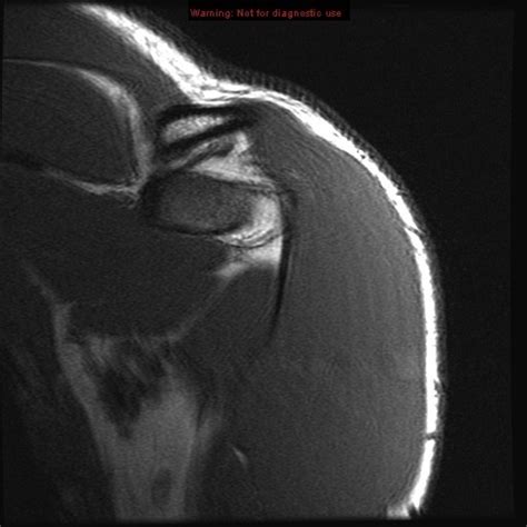 Shoulder MRI Coronal 3 Diagram | Quizlet