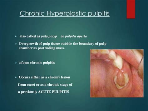 Diseases of pulp