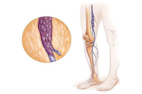 Iliac vein thrombosis – Healthy Food Near Me