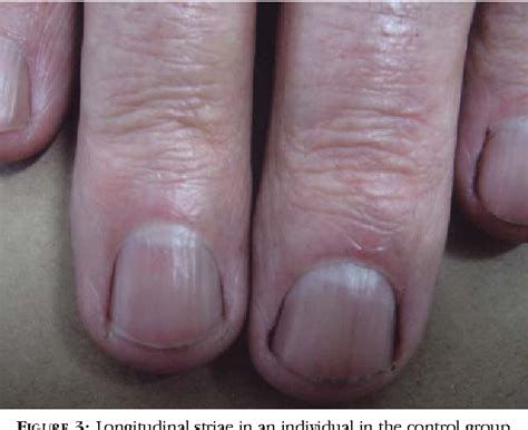 Aplasia/Hypoplasia of the 5th finger | Semantic Scholar