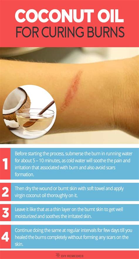 Best Ways of using Coconut Oil to Heal Burns