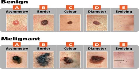 Melanoma Symptoms