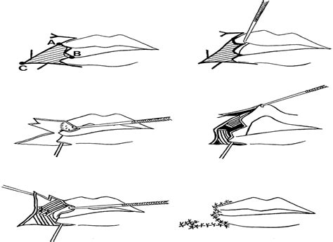 New Surgical Technique for Macrostomia Repair with Two Trian... : Plastic and Reconstructive Surgery