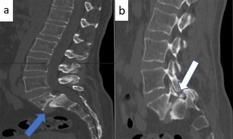 Spondylolysis Radiograph