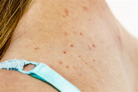 Woman with Acne Pimple on Neck Stock Photo - Image of pimple, neck: 241553810