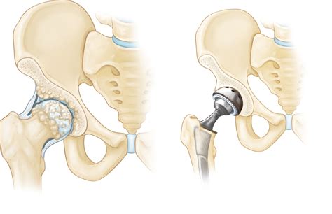 Total Joint Replacement - OrthoInfo - AAOS