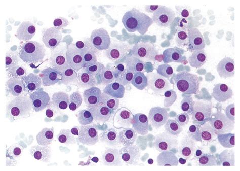 Renal Cell Carcinoma