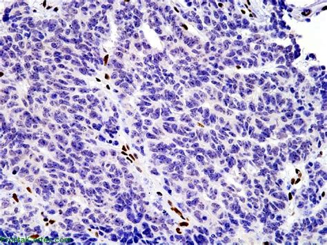 Copy of Atypical Teratoid Rhabdoid Tumor