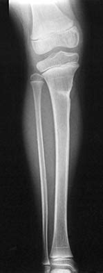 Proximal Tibia Metaphyseal Fractures - Pediatric - Pediatrics - Orthobullets