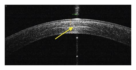 Anterior segment OCT image of the cornea showing demarcation line in ...