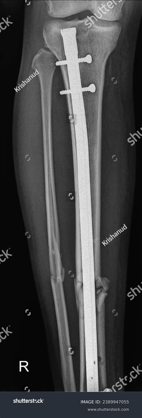 Tibial Shaft Fracture Intramedullary Nail Fixation Stock Photo 2389947055 | Shutterstock