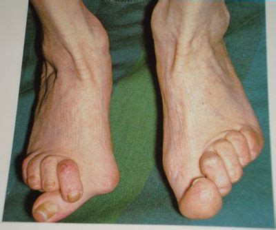 RAD - feet | Rheumatoid arthritis medications, Rheumatoid arthritis, Foot deformities