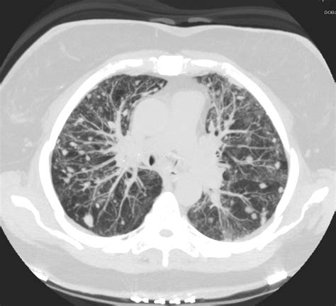 Nodules – Centrilobular | Lungs