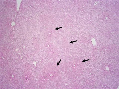 Acute Hepatic Necrosis (2023)