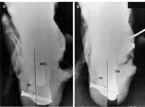 Transverse tarsal joint | Semantic Scholar