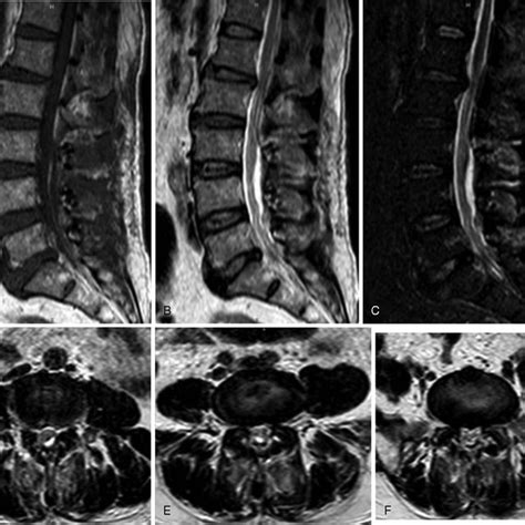 Postoperative MRI showed that the epidural fat had been removed and the... | Download Scientific ...