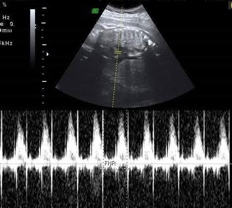 Normal 17 week baby Ultrasound. - Ultrasoundfeminsider