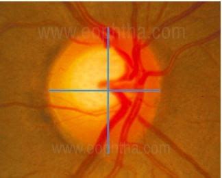 Evaluation of The Optic Nerve Head in Glaucoma