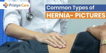 Difference Between Umbilical and Paraumbilical Hernia - Pristyn Care