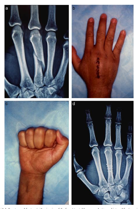 Transverse Fracture Hand Treatment