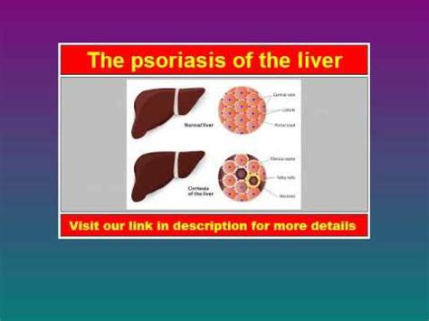 Psoriasis of the Liver the video for what is Psoriasis of the Liver? - YouTube