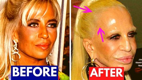 Botched Plastic Surgery Bad Plastic Surgery Photos Be - vrogue.co