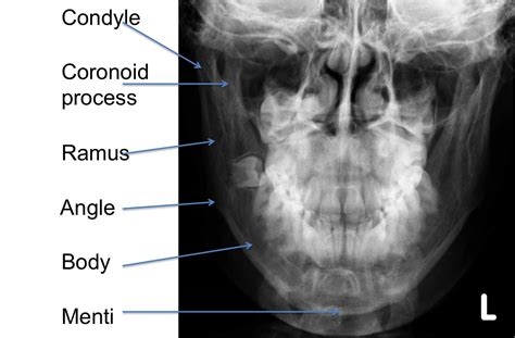 Mandible Anatomy Radiology - Anatomical Charts & Posters