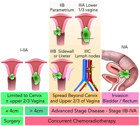 Cervix Cancer Staging