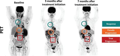 PET/CT pinpoints Hodgkin's lymphoma treatment response