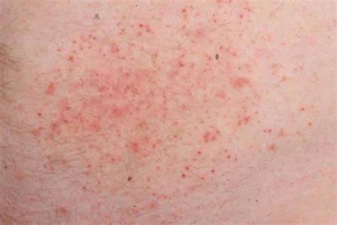 Dermatitis herpetiformis: Causes, treatment, and pictures