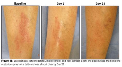 Physician and Patient Assessment of Triamcinolone Acetonide Spray for Steroid-responsive ...