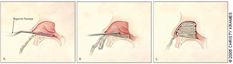 Management of Epistaxis | AAFP