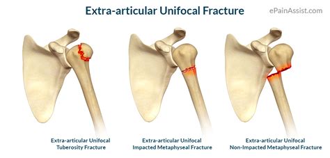 Proximal Humerus Fracture: Treatment, Exercises, Causes, Symptoms