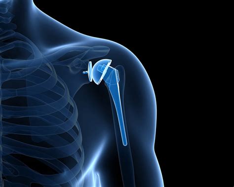 Shoulder Arthroplasty| Joint Replacement | Proliance Puget Sound ...