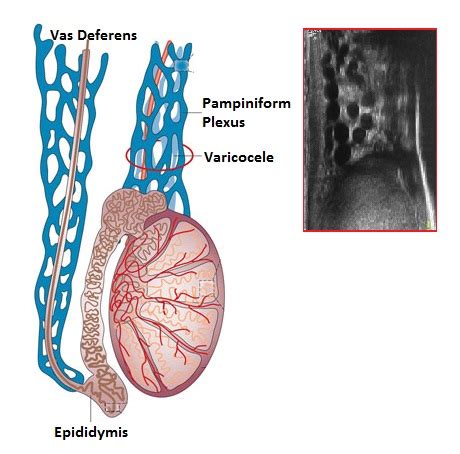 Varicocele – Sonographic Tendencies