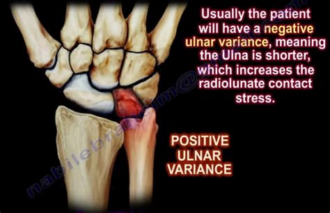 Kienbock’s disease — OrthopaedicPrinciples.com