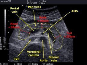 Long Pancreas w/vascularity labeled (With images) | Ultrasound sonography, Sonography ...