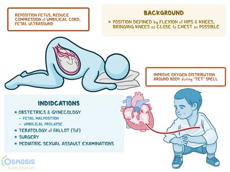 Knee-Chest Position: What Is It, Uses, and More | Osmosis