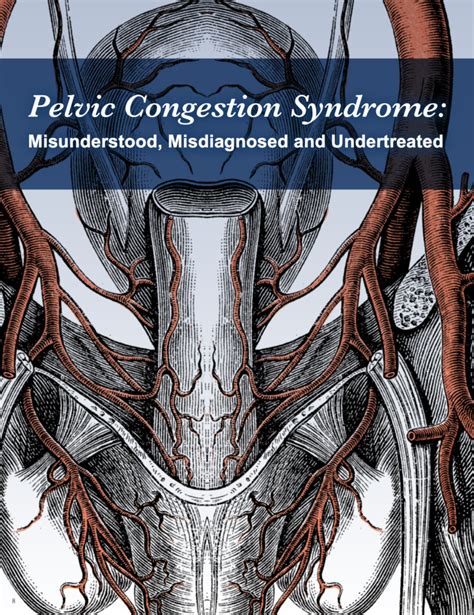 Pelvic Congestion Syndrome - Vein Center, Dallas, TX