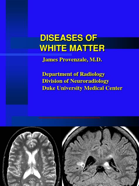 28 - White Matter Diseases | PDF | Multiple Sclerosis | Myelin