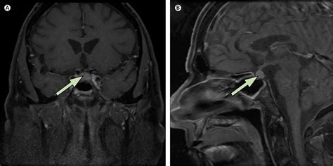 Autoimmune hypophysitis - The Lancet Oncology