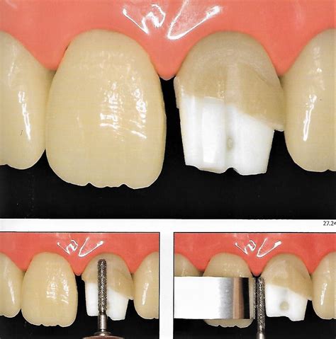 Anterior Crown Preparation | Dental Esthetics