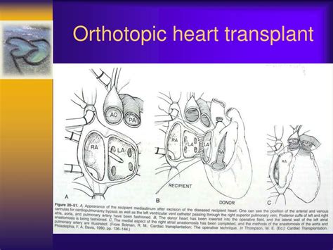 PPT - Anesthesia Following Heart Transplantation PowerPoint ...