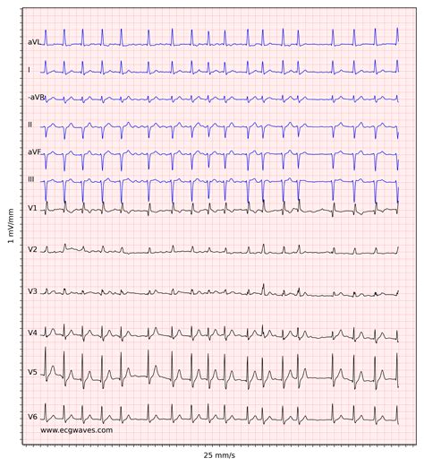 Atrial fibrillation: ECG, classification, causes, risk factors & management – ECG & ECHO