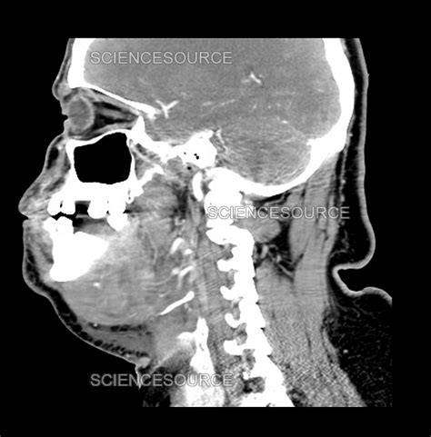 Ludwigs Angina Radiology