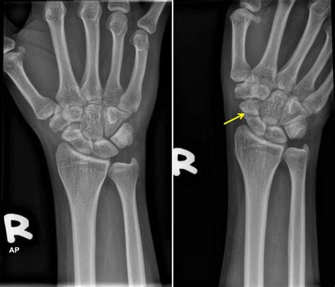 Scaphoid fracture – Radiology Cases